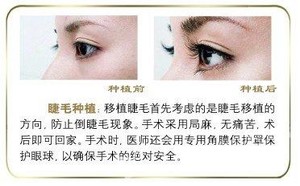 北京邦妍医疗美容门诊部【睫毛种植】效果怎么样?