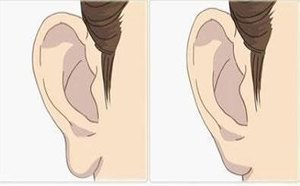 北京嘉韵美容【耳垂矫正】大概需要多少钱?