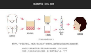 镇平县中医院自体脂肪丰额头的优势有哪些?