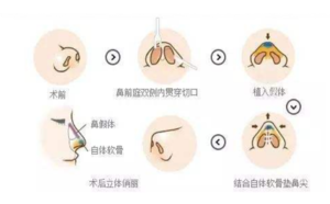 北京春语医疗美容的假体隆鼻特点是什么?