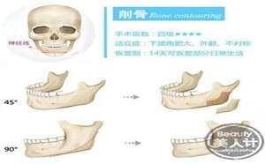 科普:削骨类整形主要过程